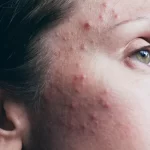 Sivilce Akne Vulgaris Nedir?