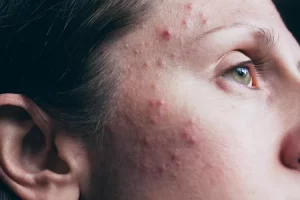 Sivilce Akne Vulgaris Nedir?
