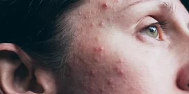 Sivilce Akne Vulgaris Nedir?