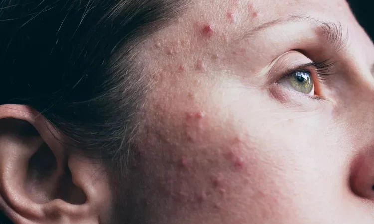 Sivilce Akne Vulgaris Nedir?