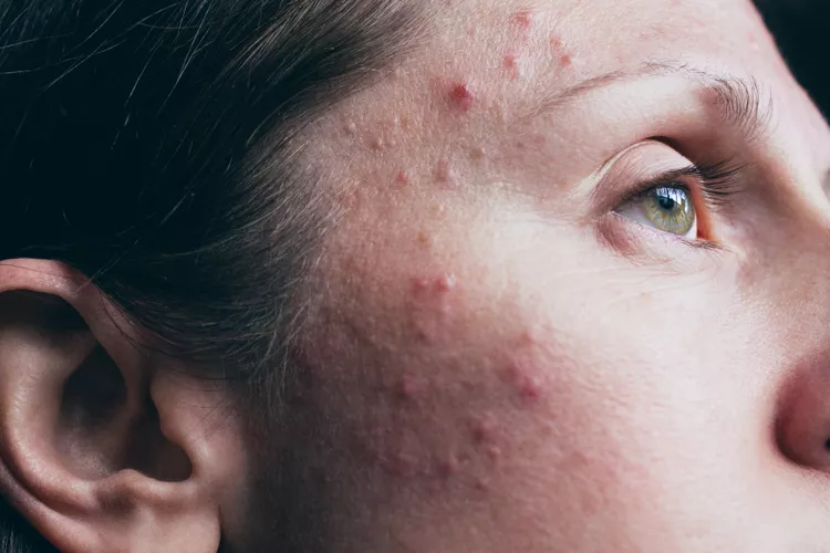 Sivilce Akne Vulgaris Nedir?